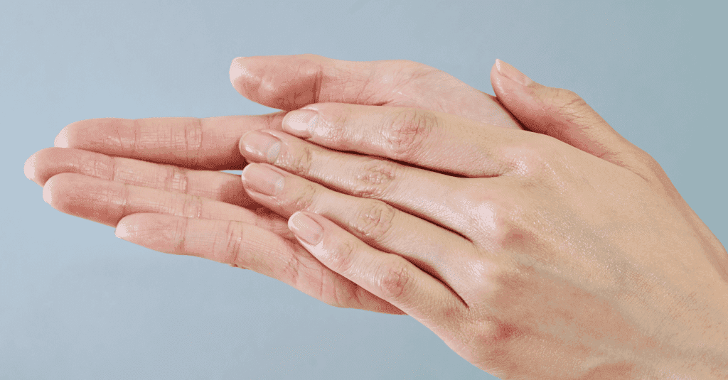 Veias inestéticas nas mãos e varizes nos pés têm tratamento