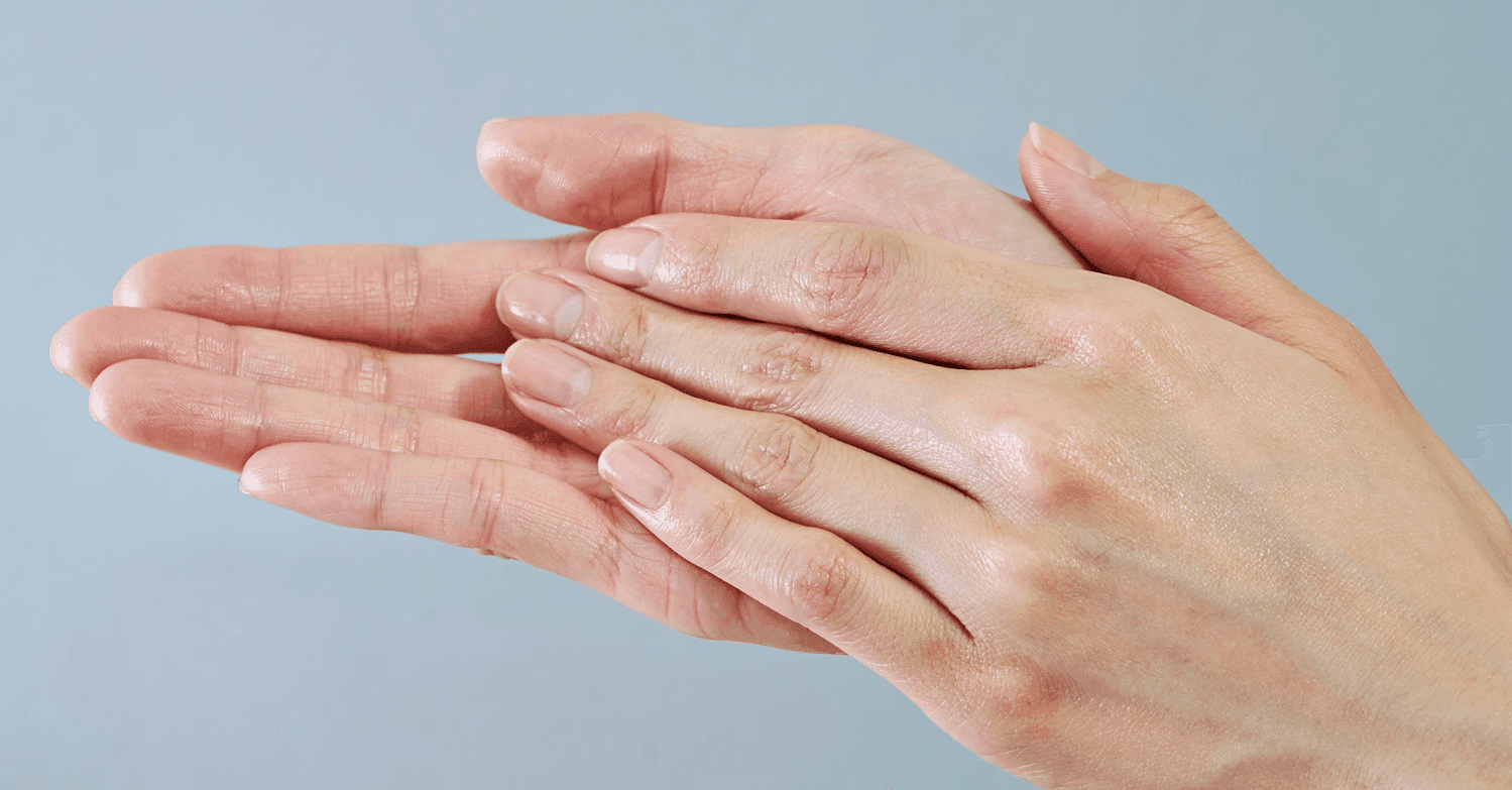 Veias inestéticas nas mãos e varizes nos pés têm tratamento