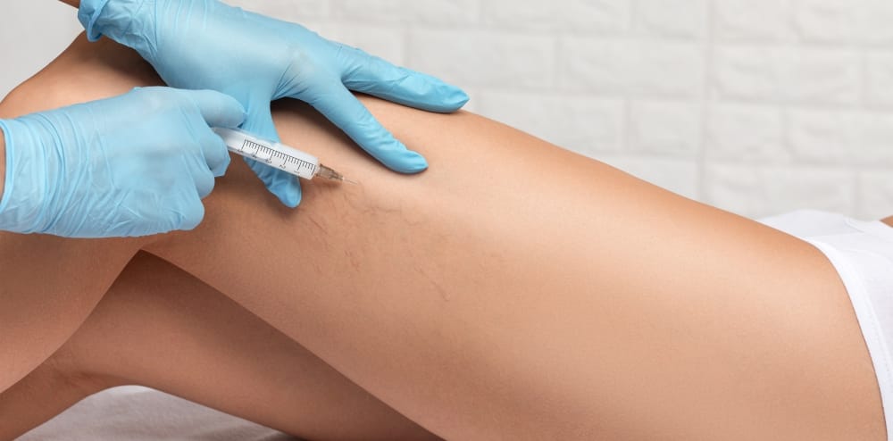 Tratamento de varizes: entenda por que elas voltam (e não deveriam)