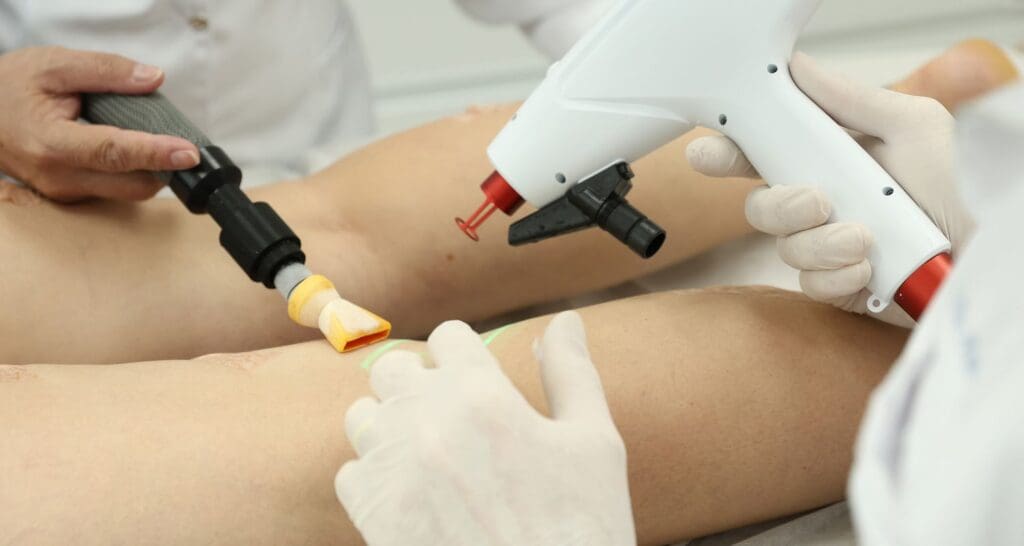 Conheça o tratamento para varizes a laser transdérmico: uma técnica moderna, segura, que alivia a dor, melhora a estética e não requer repouso.