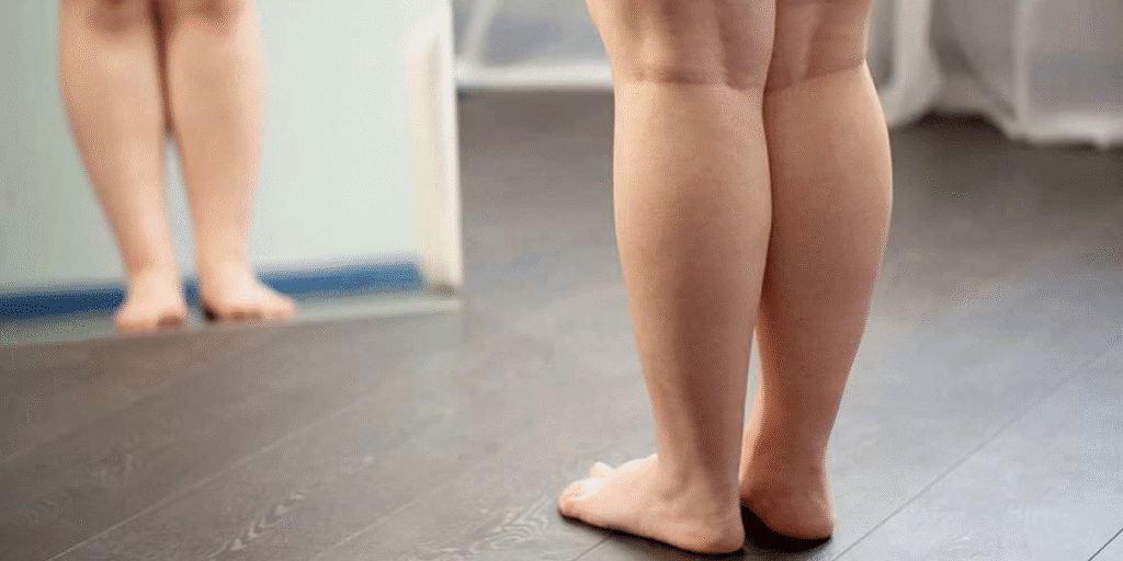 lipedema trata em Joinville