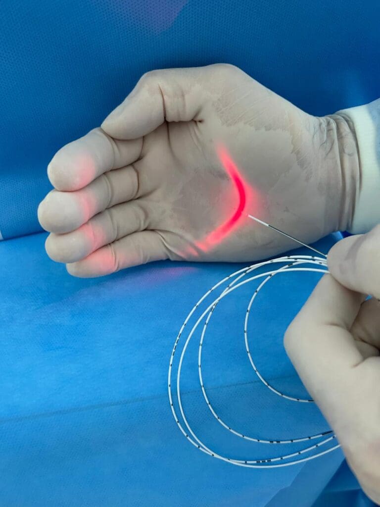 cirurgia de varizes a laser - Dr. Fabricio Duarte